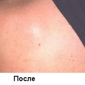 внимание ! удаление тату лезером. Киев 